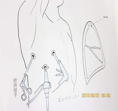 手術創はとても小さい